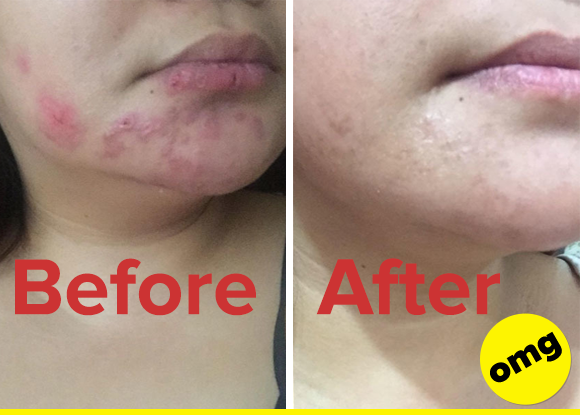 pimples breaking out