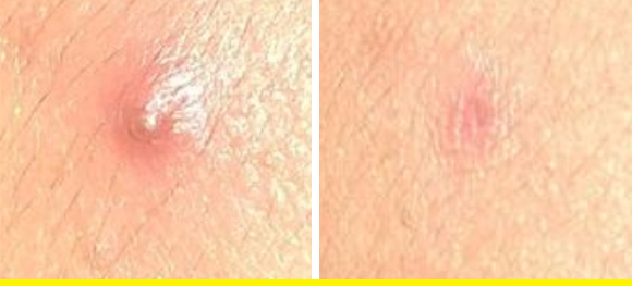 how to get rid of a pimple in a hurry